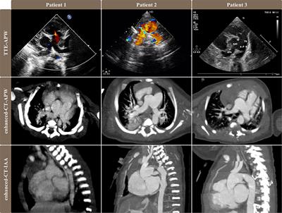 Outcomes of One-Stage Surgical Repair for Berry Syndrome in Neonates